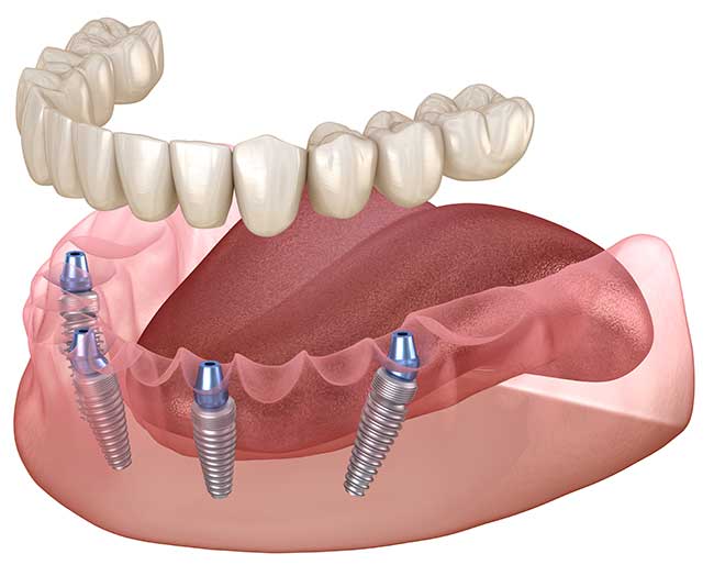 Имплантация зубов: современный подход к восстановлению улыбки